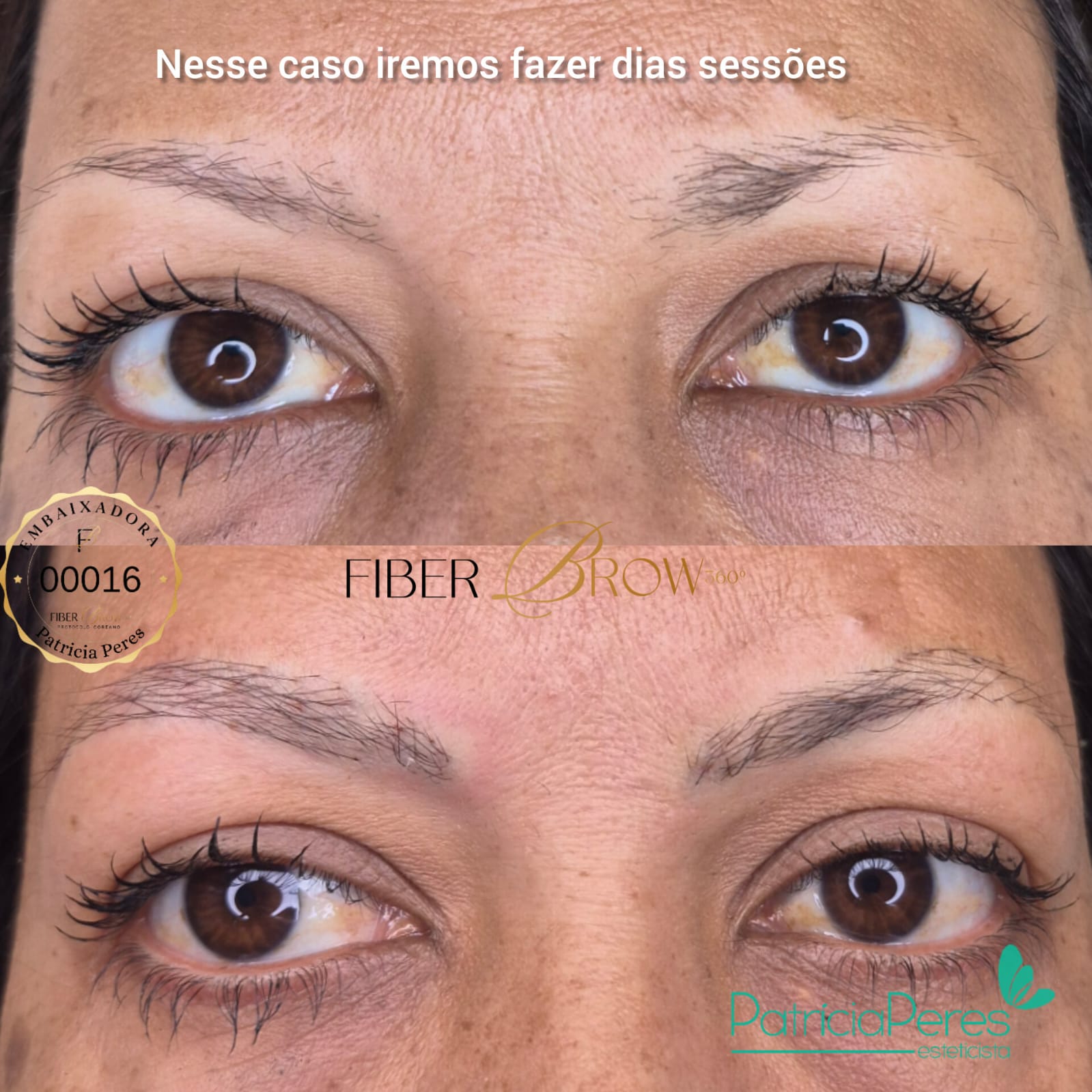 Antes e depois, primeira sessão, caso de alopecia, cliente Neide