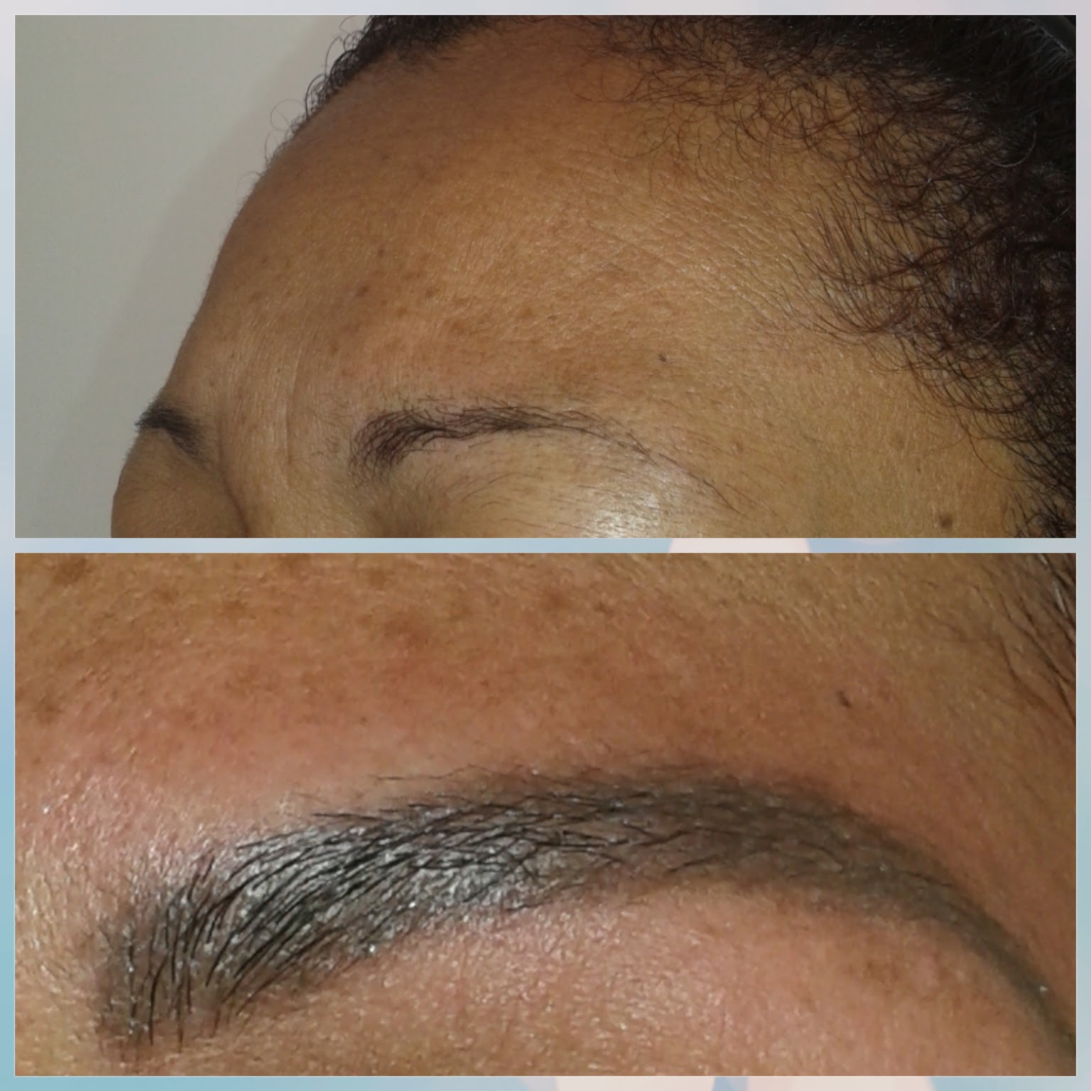 Antes e depois com moldura, pigmento acinzentado remarcado