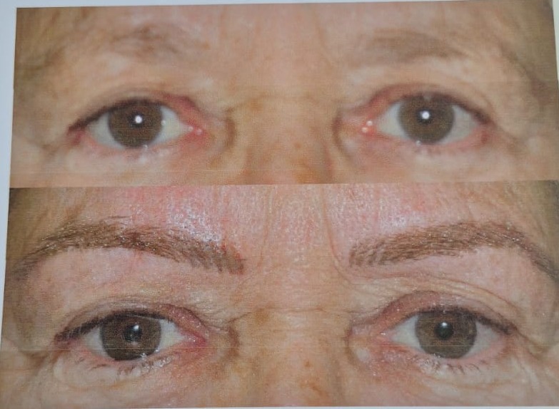 Folha impressa: antes e depois de maquiagem definitiva sobrancelhas, técnica fio a fio