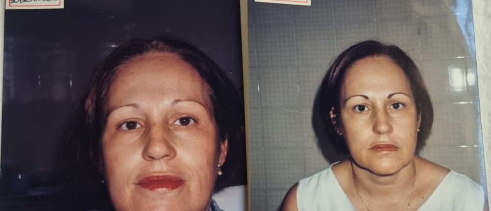Antes e depois de maquiagem definitiva, close nas sobrancelhas, cliente de blusa azul