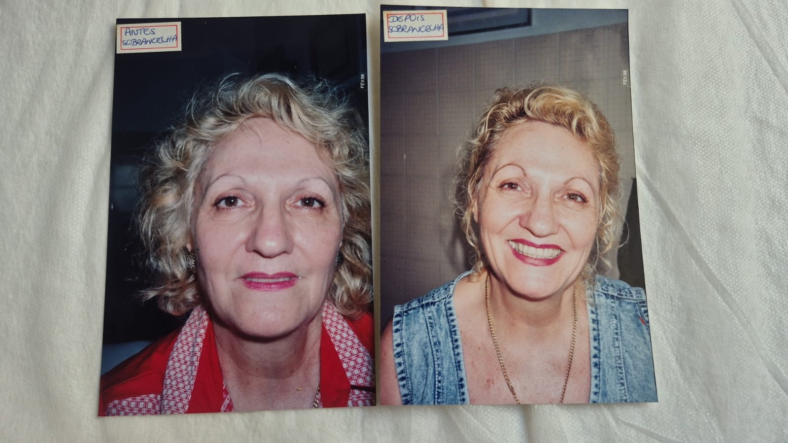 Antes e depois de maquiagem definitiva, cliente loira, fevereiro de 1998