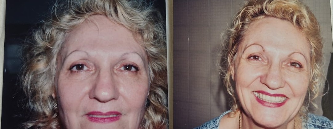 Antes e depois de maquiagem definitiva, close nas sobrancelhas, cliente loira