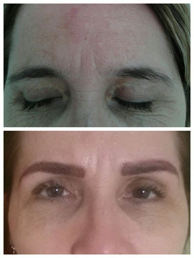 Antes e depois compacto: sobrancelha falhada preenchida com micropigmentação
